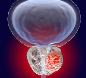 Prostate